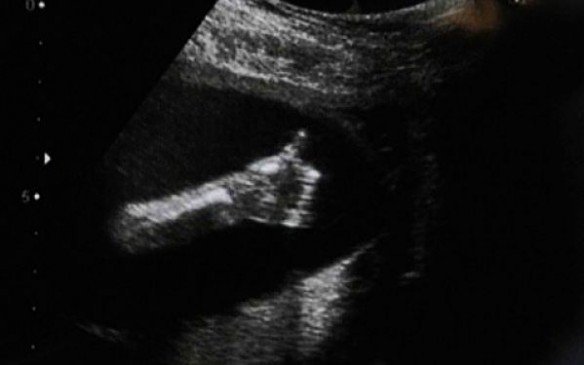Negaidīts pārsteigums: grūtnieces vēderā atrod 'surikatu'