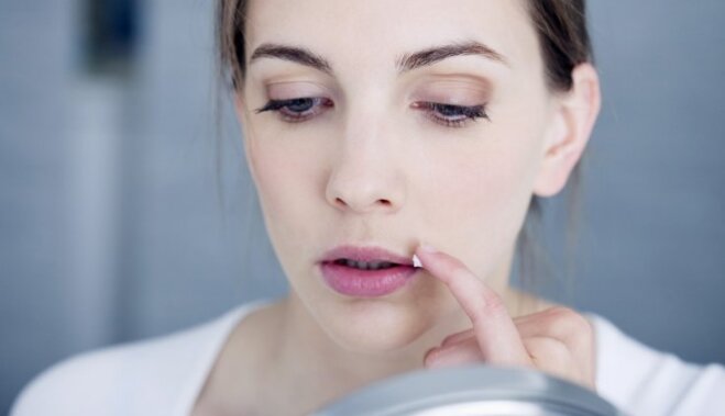 Как победить простуду на губах: советы дерматолога