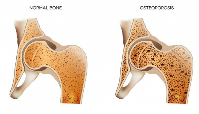 Как спасти свои кости от остеопороза + короткий тест