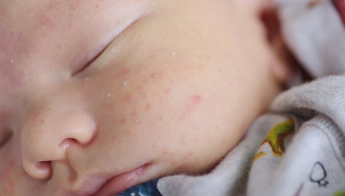 Zīdaiņu ādas problēmas – kas ir jaundzimušo akne un toksiskā eritēma